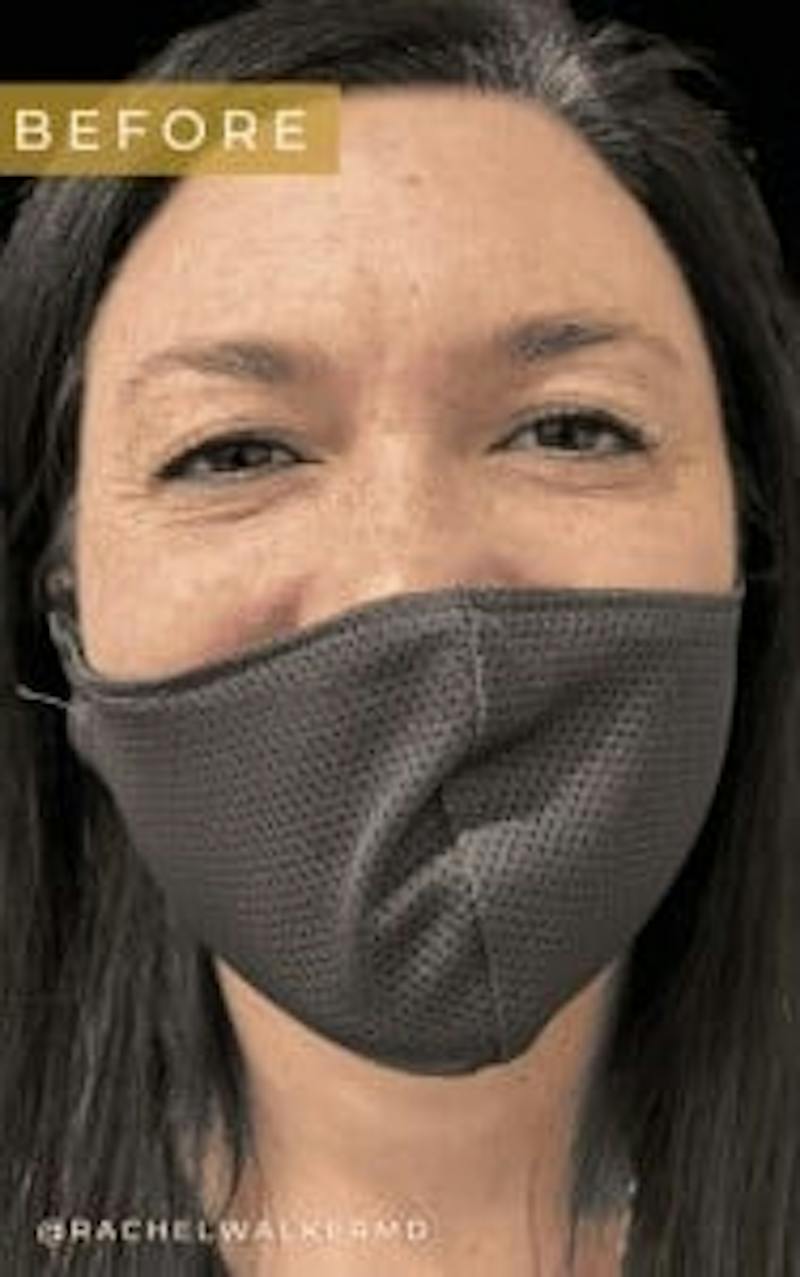 Upper + Lower Blepharoplasty Before & After Gallery - Patient 970249 - Image 3