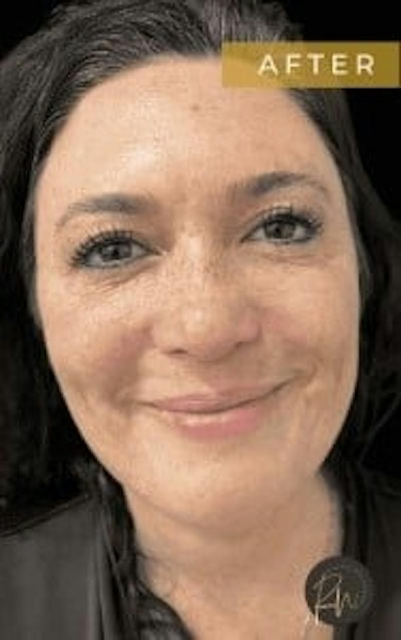 Upper + Lower Blepharoplasty Before & After Gallery - Patient 970249 - Image 4