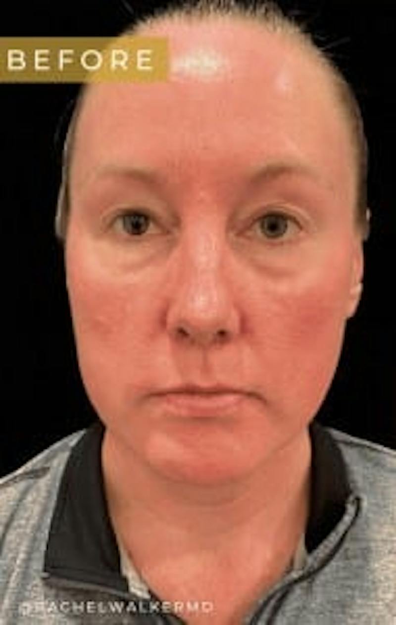 Upper + Lower Blepharoplasty Before & After Gallery - Patient 190168 - Image 1
