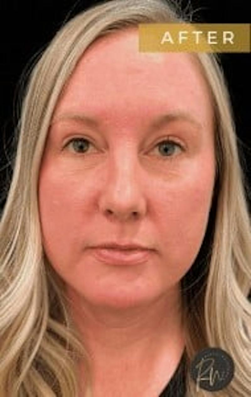 Upper + Lower Blepharoplasty Before & After Gallery - Patient 190168 - Image 2