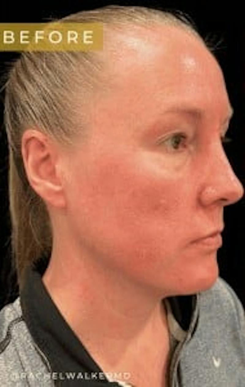 Upper + Lower Blepharoplasty Before & After Gallery - Patient 190168 - Image 3
