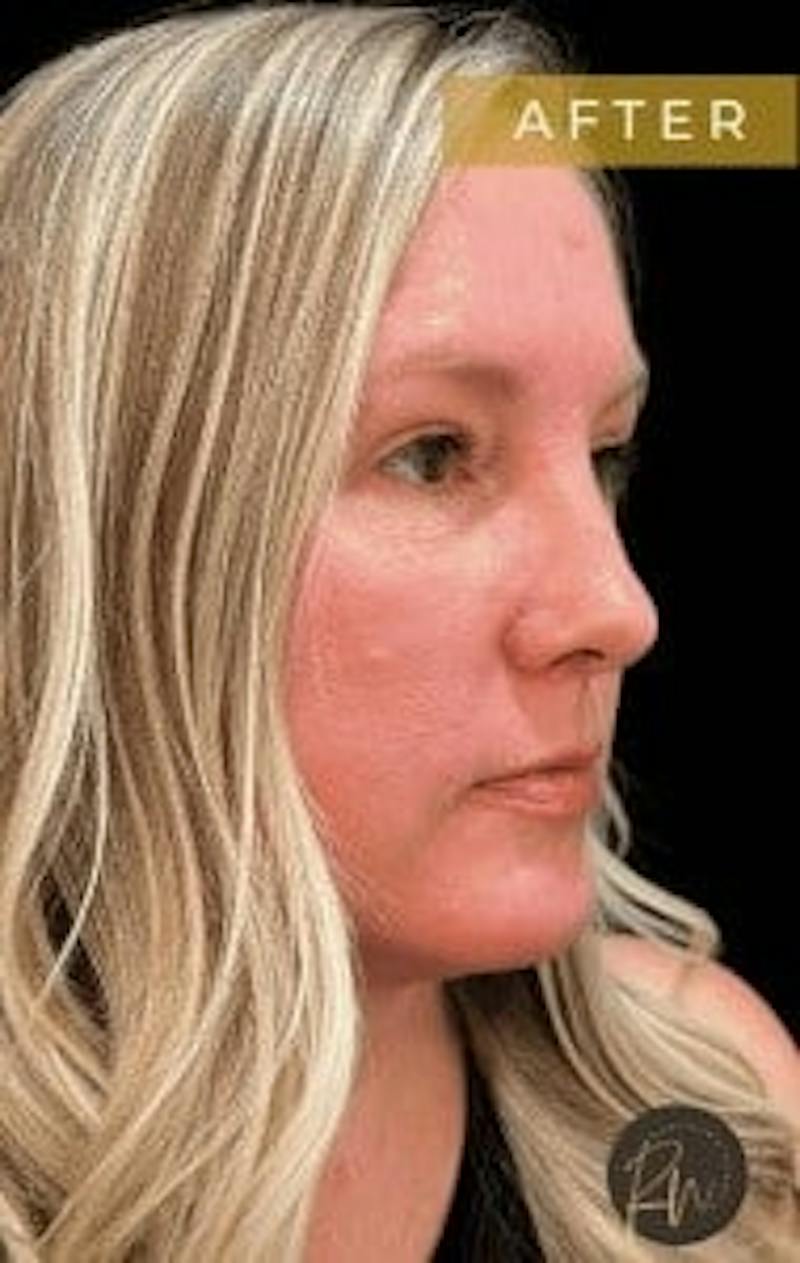 Upper + Lower Blepharoplasty Before & After Gallery - Patient 190168 - Image 4
