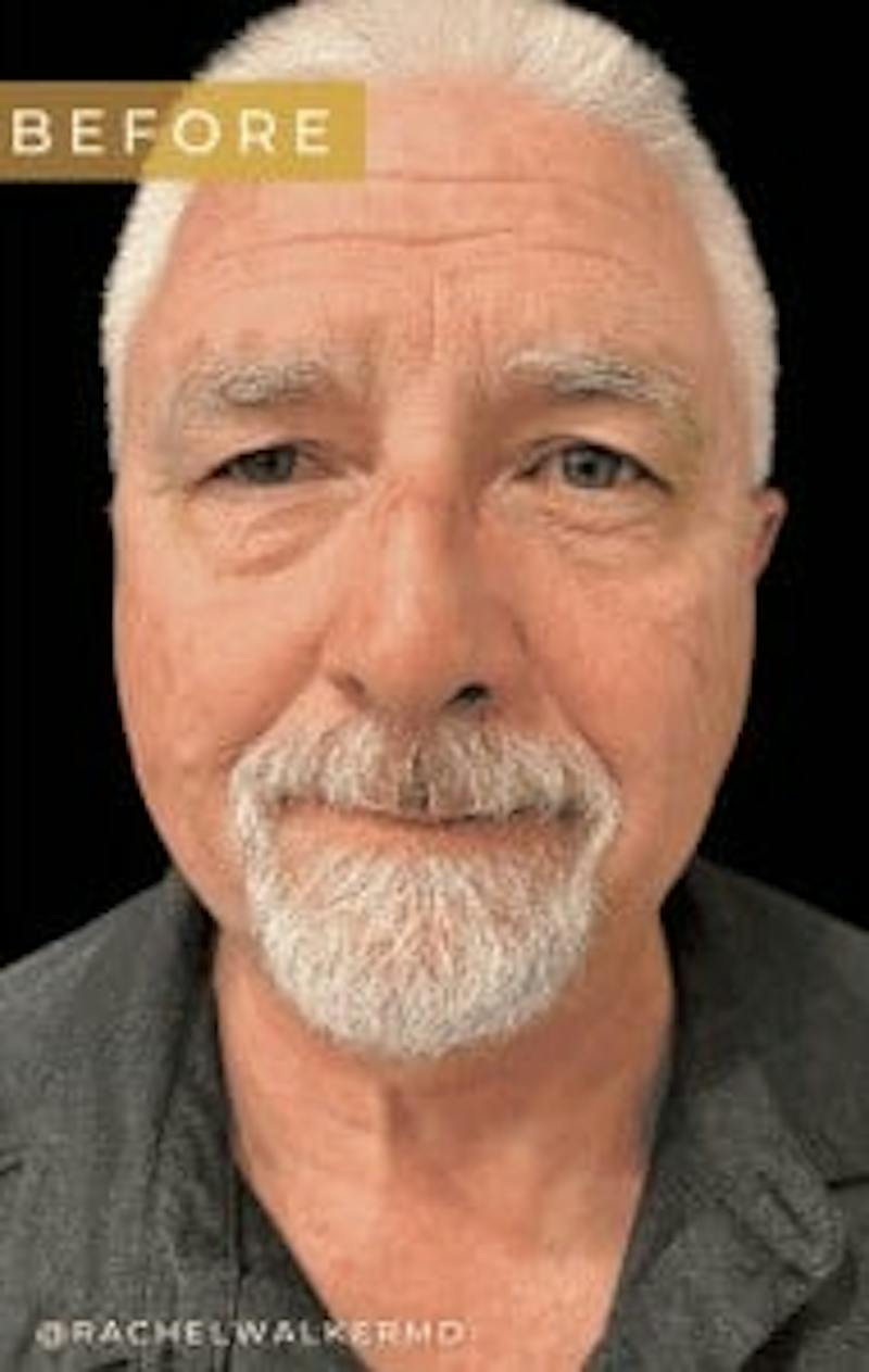 Upper + Lower Blepharoplasty Before & After Gallery - Patient 195015 - Image 1