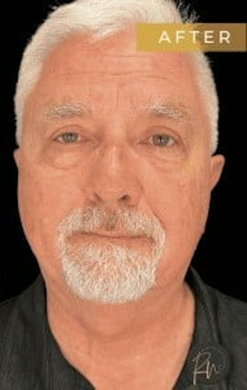 Upper + Lower Blepharoplasty Before & After Gallery - Patient 195015 - Image 2
