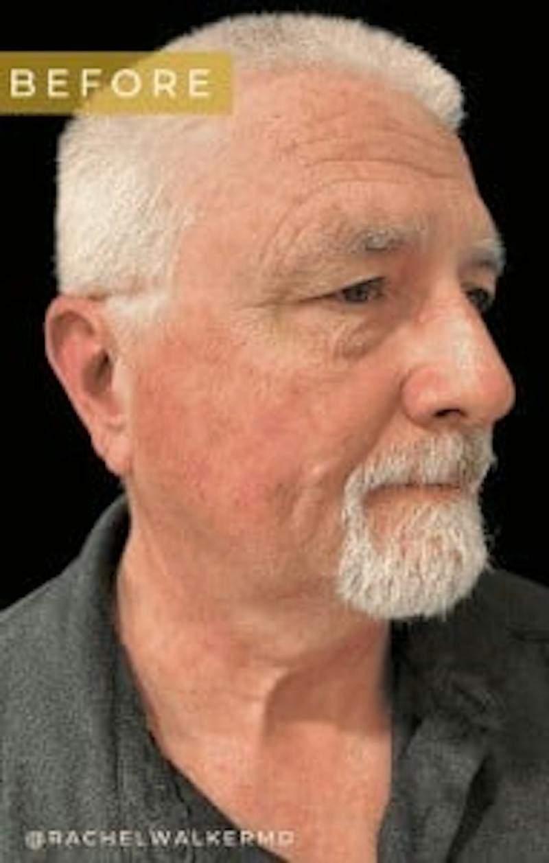 Upper + Lower Blepharoplasty Before & After Gallery - Patient 195015 - Image 3