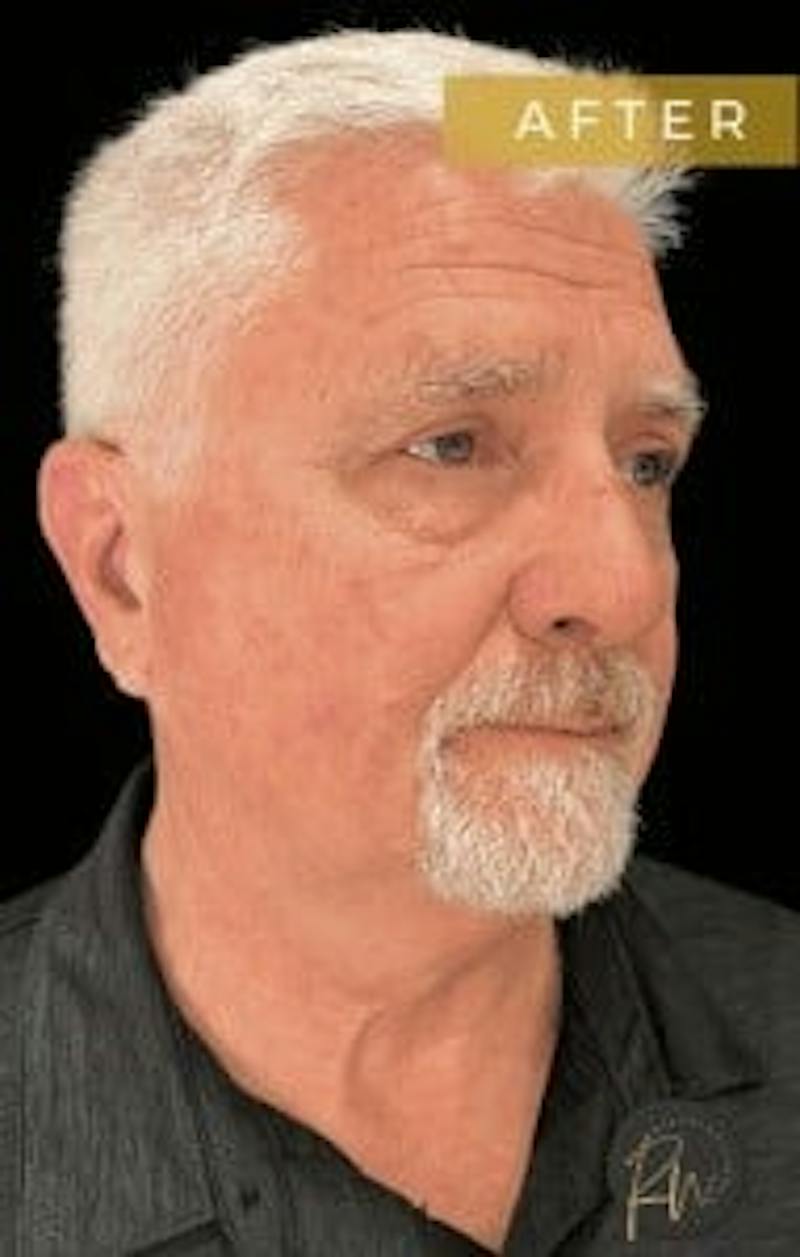Upper + Lower Blepharoplasty Before & After Gallery - Patient 195015 - Image 4