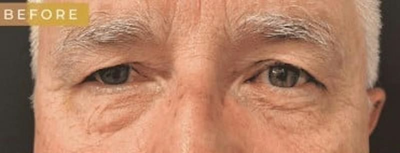 Upper + Lower Blepharoplasty Before & After Gallery - Patient 195015 - Image 5