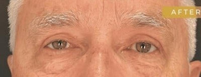 Upper + Lower Blepharoplasty Before & After Gallery - Patient 195015 - Image 6