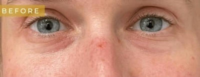 Upper + Lower Blepharoplasty Before & After Gallery - Patient 160094 - Image 1