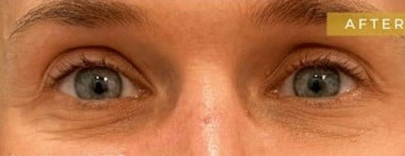 Upper + Lower Blepharoplasty Before & After Gallery - Patient 160094 - Image 2