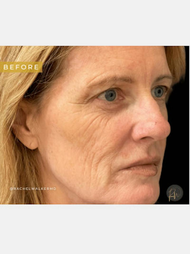 Upper + Lower Blepharoplasty Before & After Gallery - Patient 684061 - Image 1