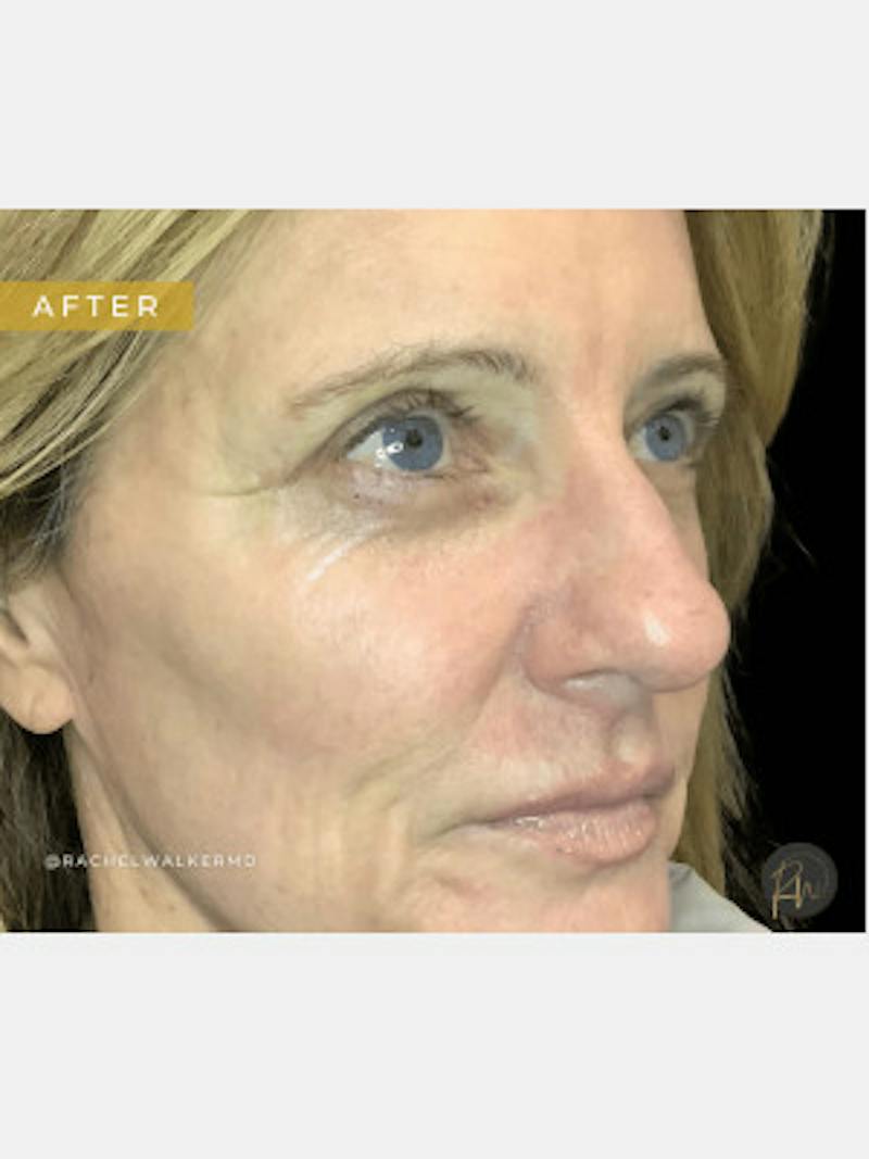 Upper + Lower Blepharoplasty Before & After Gallery - Patient 684061 - Image 2