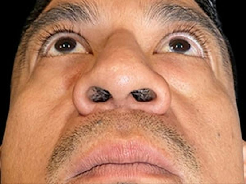 Upper + Lower Blepharoplasty Before & After Gallery - Patient 338099 - Image 1