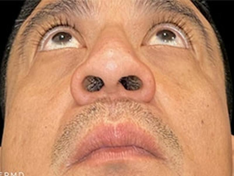 Upper + Lower Blepharoplasty Before & After Gallery - Patient 338099 - Image 2