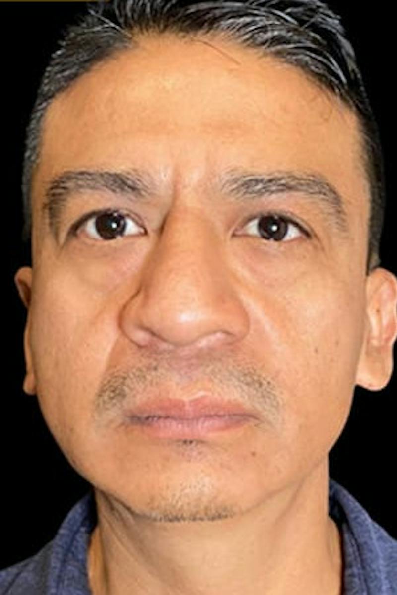 Upper + Lower Blepharoplasty Before & After Gallery - Patient 338099 - Image 3