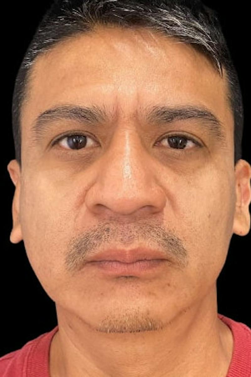 Upper + Lower Blepharoplasty Before & After Gallery - Patient 338099 - Image 4