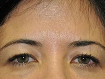 Upper + Lower Blepharoplasty Before & After Gallery - Patient 241376 - Image 1