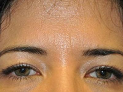 Upper + Lower Blepharoplasty Before & After Gallery - Patient 241376 - Image 2