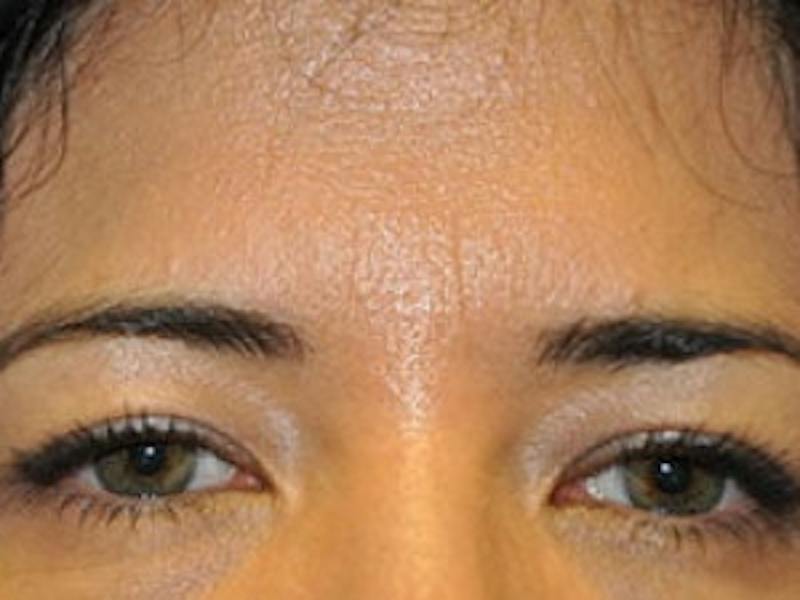 Upper + Lower Blepharoplasty Before & After Gallery - Patient 241376 - Image 2