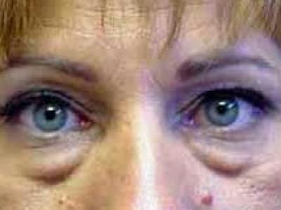 Upper + Lower Blepharoplasty Before & After Gallery - Patient 179359 - Image 1