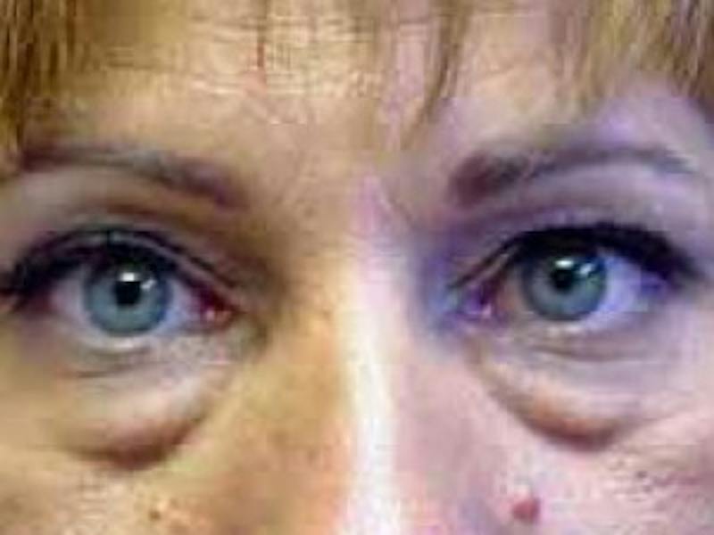 Upper + Lower Blepharoplasty Before & After Gallery - Patient 179359 - Image 1