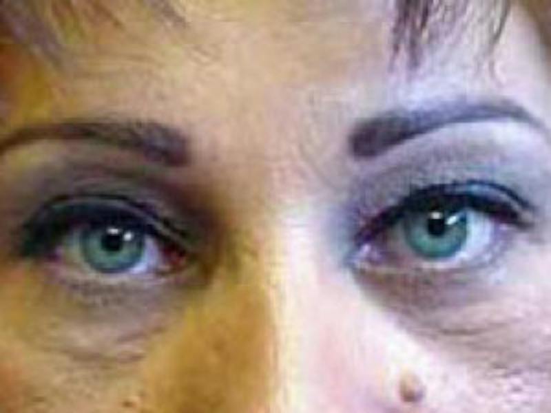 Upper + Lower Blepharoplasty Before & After Gallery - Patient 179359 - Image 2