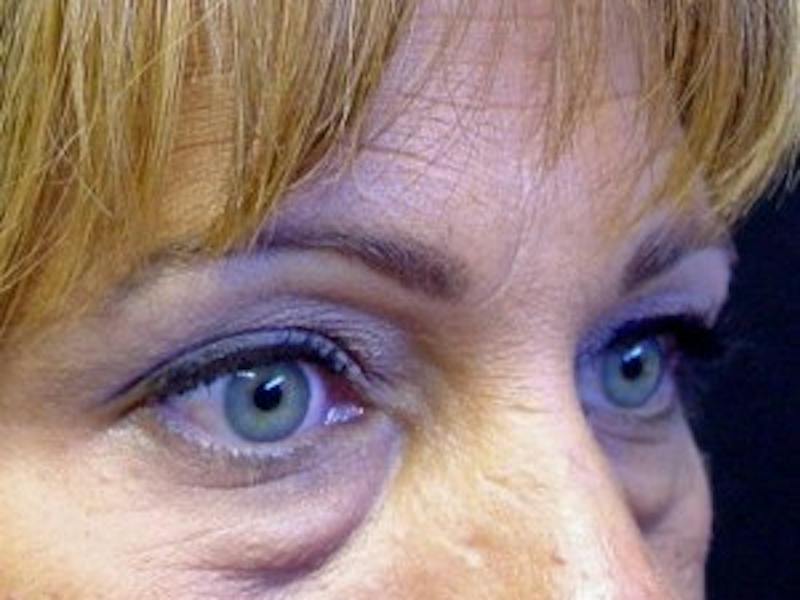 Upper + Lower Blepharoplasty Before & After Gallery - Patient 179359 - Image 3