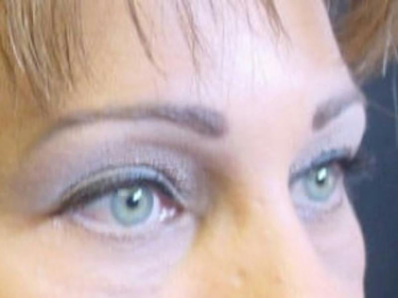 Upper + Lower Blepharoplasty Before & After Gallery - Patient 179359 - Image 4