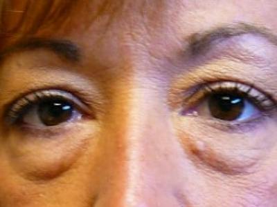 Upper + Lower Blepharoplasty Before & After Gallery - Patient 123592 - Image 1