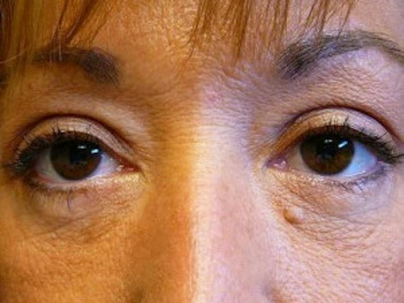 Upper + Lower Blepharoplasty Before & After Gallery - Patient 123592 - Image 2