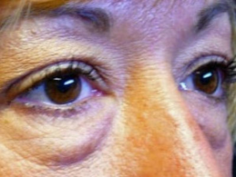 Upper + Lower Blepharoplasty Before & After Gallery - Patient 123592 - Image 3