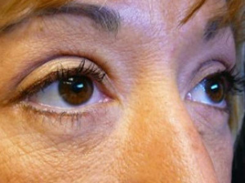 Upper + Lower Blepharoplasty Before & After Gallery - Patient 123592 - Image 4