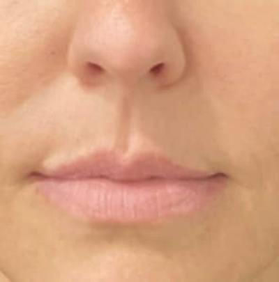Lip Lift Before & After Gallery - Patient 344921 - Image 1
