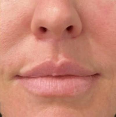 Lip Lift Before & After Gallery - Patient 344921 - Image 2