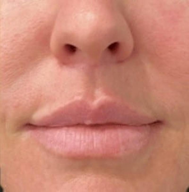 Lip Lift Before & After Gallery - Patient 344921 - Image 2