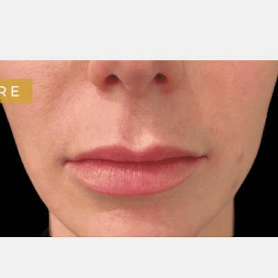 Lip Lift Before & After Gallery - Patient 275258 - Image 1