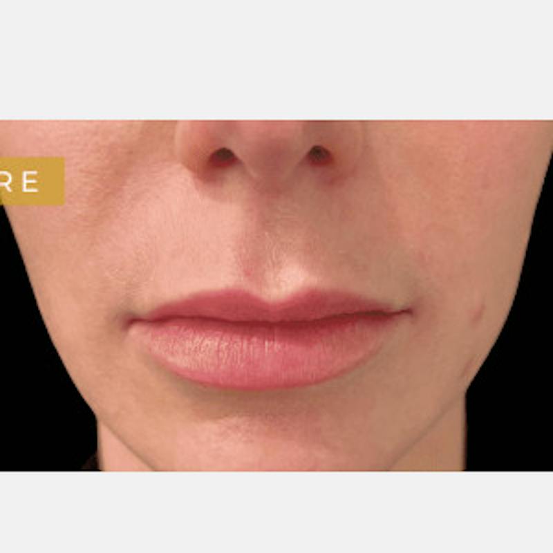 Lip Lift Before & After Gallery - Patient 275258 - Image 1
