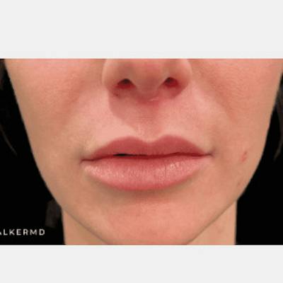 Lip Lift Before & After Gallery - Patient 275258 - Image 2