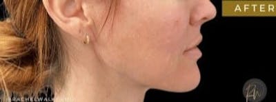Renuvion Neck Tightening Before & After Gallery - Patient 131124 - Image 2