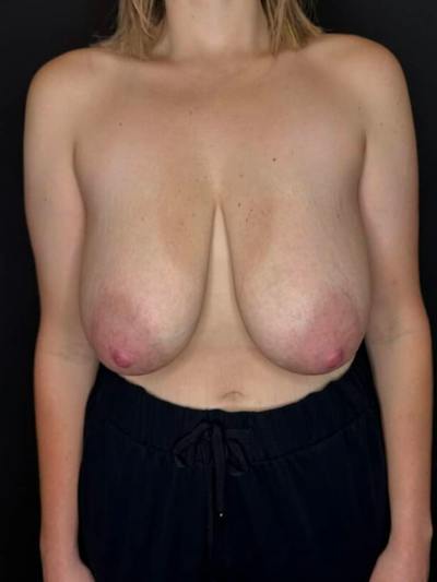Breast Lift Before & After Gallery - Patient 250637 - Image 1