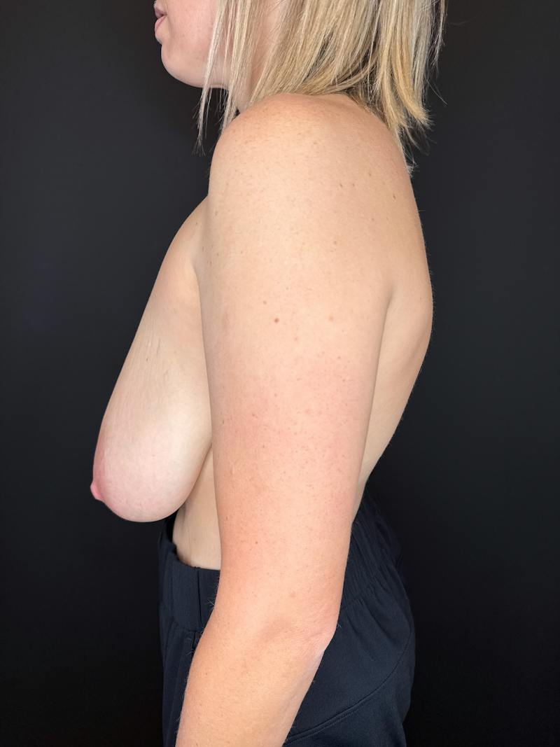 Breast Lift Before & After Gallery - Patient 250637 - Image 5