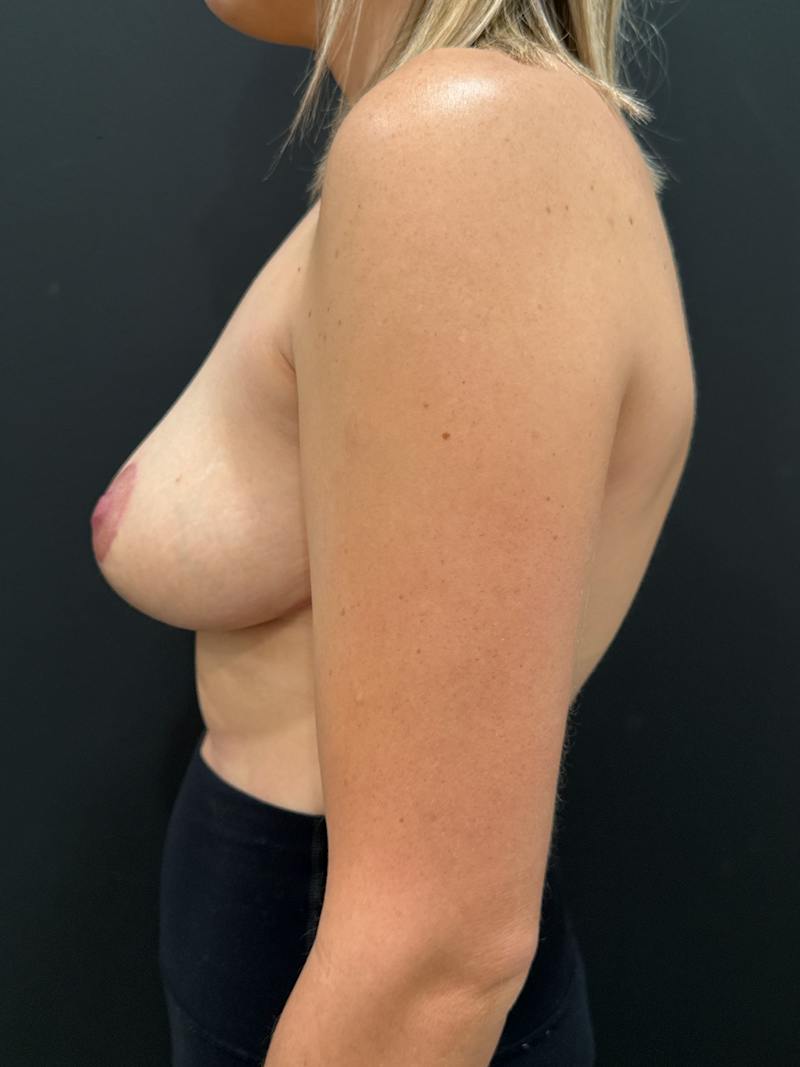 Breast Lift Before & After Gallery - Patient 250637 - Image 6