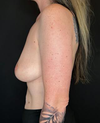 Breast Reduction Before & After Gallery - Patient 299292 - Image 6