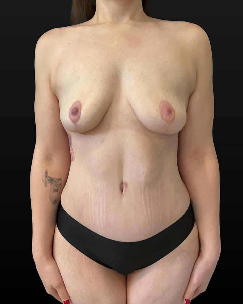 Mommy Makeover Before & After Gallery - Patient 401418 - Image 2