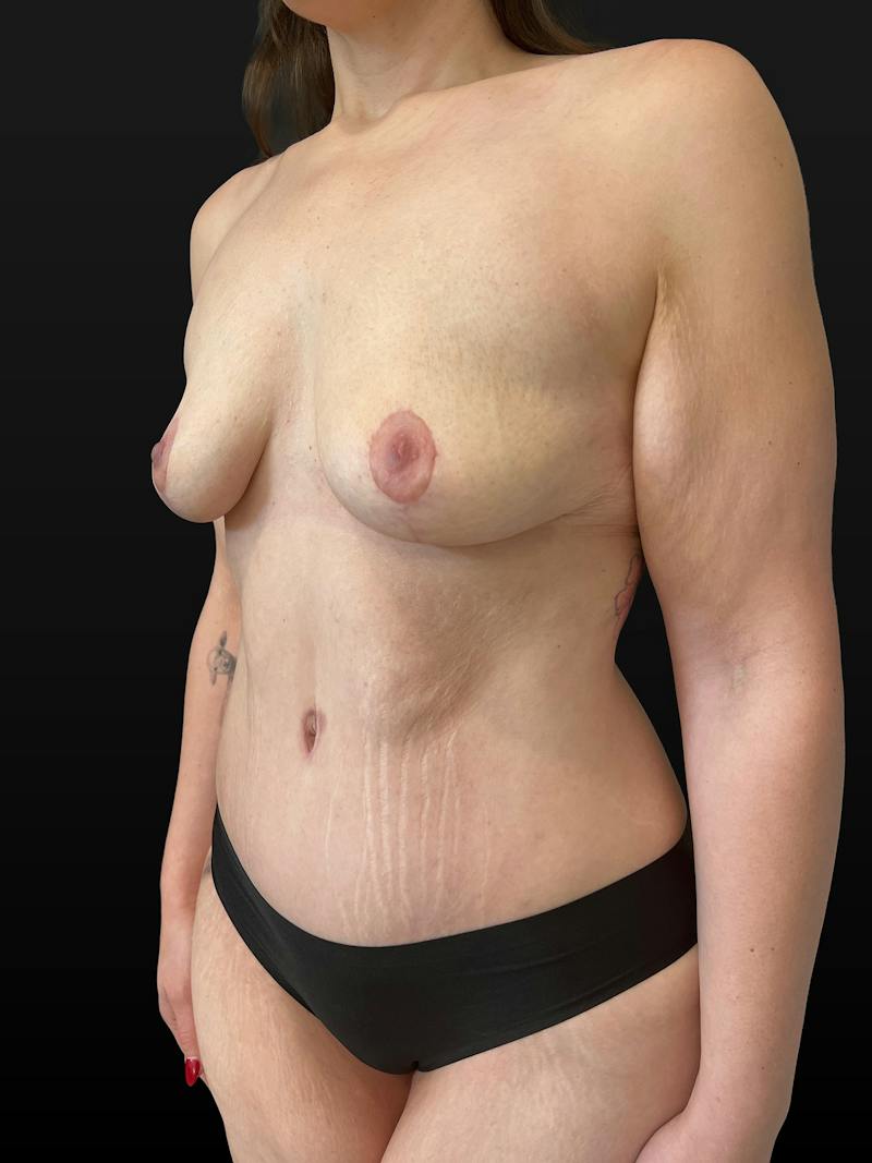 Mommy Makeover Before & After Gallery - Patient 401418 - Image 4