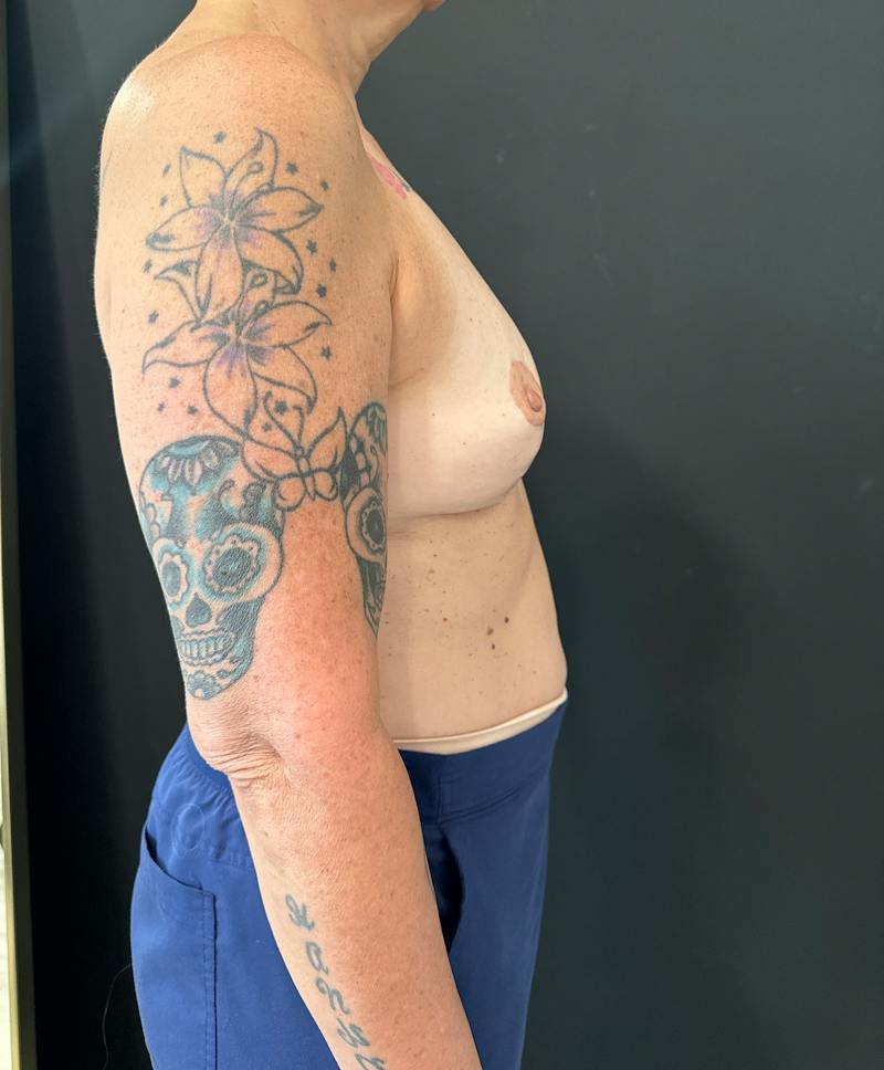 Breast Lift Before & After Gallery - Patient 248816 - Image 6