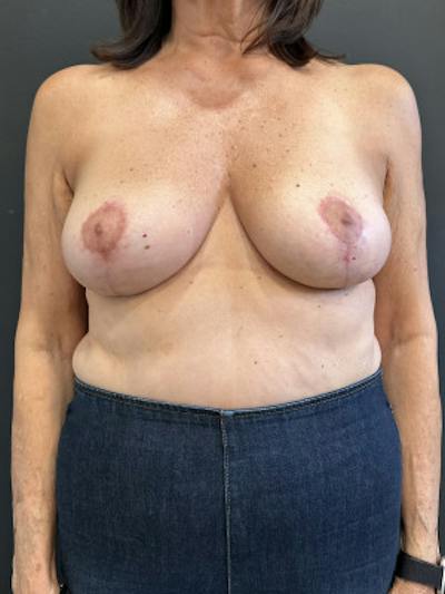 Breast Lift Before & After Gallery - Patient 206681 - Image 2