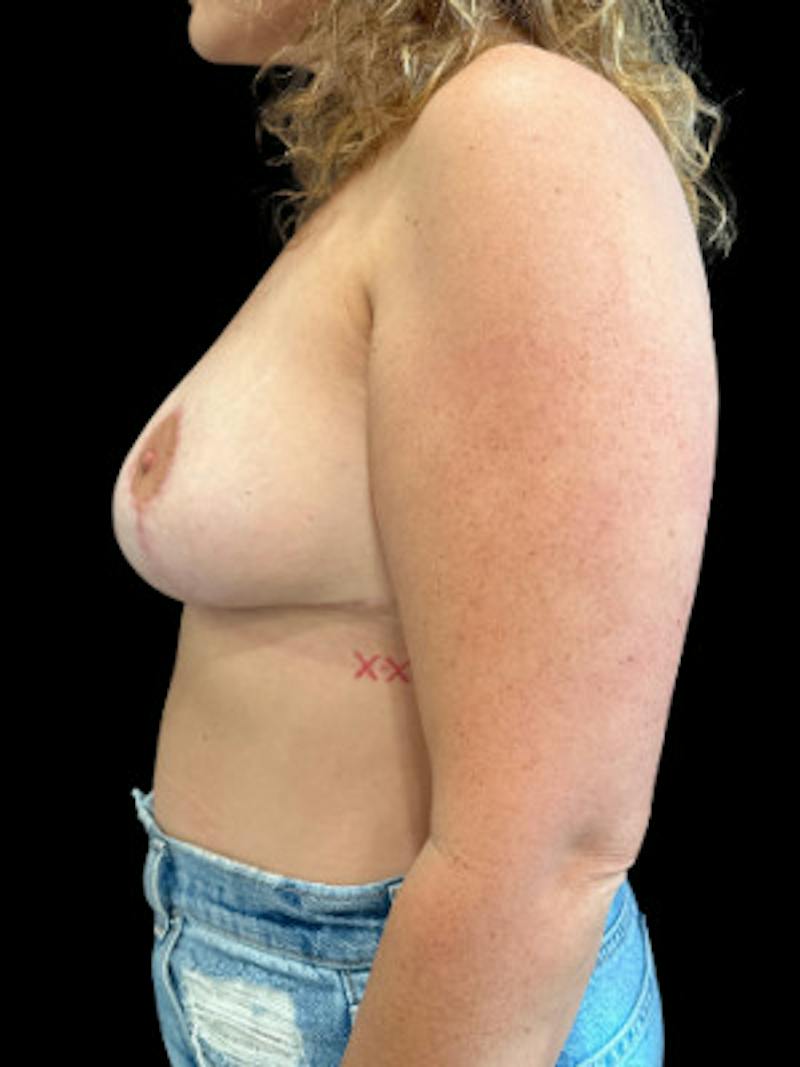 Breast Lift Before & After Gallery - Patient 628994 - Image 4