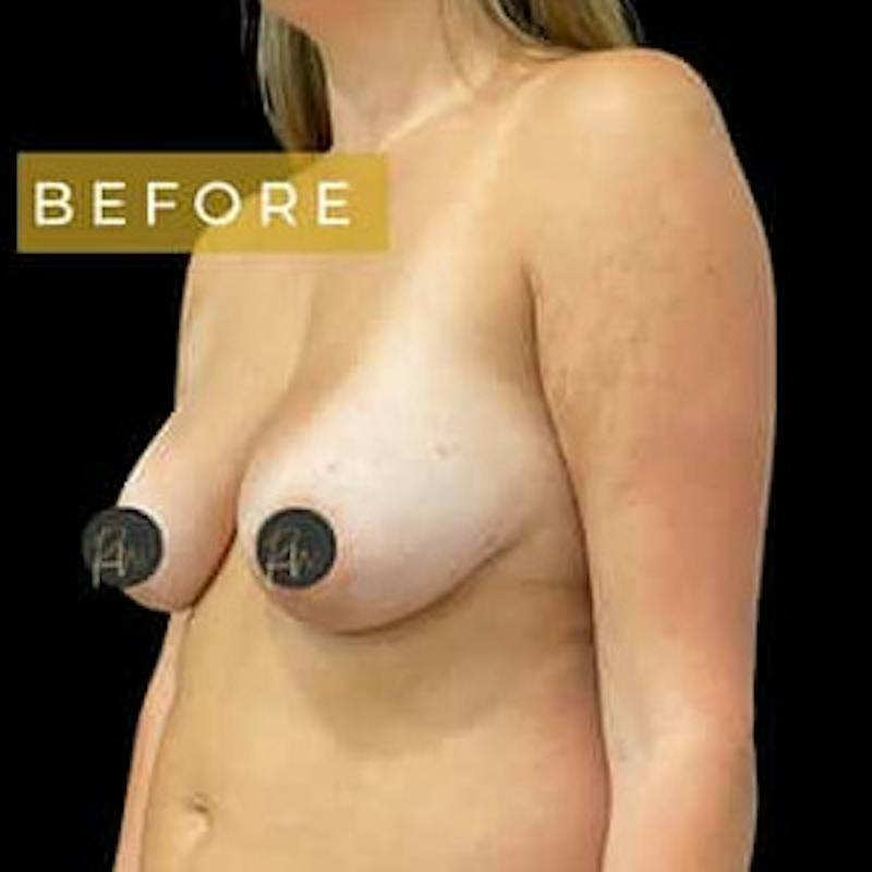 Breast Lift Before & After Gallery - Patient 131852 - Image 1