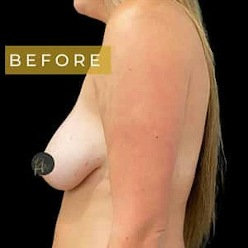 Breast Lift Before & After Gallery - Patient 131852 - Image 3